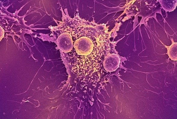 T lymphocytes and cancer cell on colored scanning electron micrograph machine
